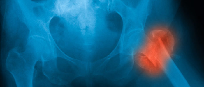 X-ray,Image,Of,Both,Hip,Showing,Femur,Fracture,At,Left