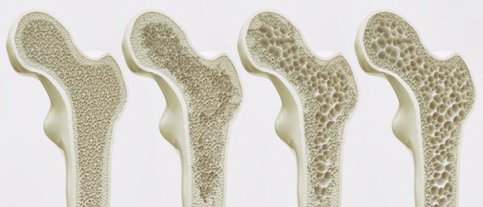 The,Four,Stages,Of,Osteoporosis,-,Illustration